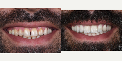 Case: 7582 - before and after photo of 35-44 year old man treated with Porcelain Veneers, Lumineers, Smile Makeover, Zoom Whitening by Kerem Turgut Atasoy, DDS, PhD