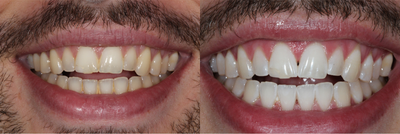 Case: 7583 - before and after photo of 25-34 year old man treated with Zoom Whitening by Brian Alan Klaich, DMD