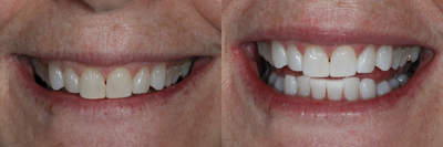 Case: 7584 - before and after photo of 65-74 year old woman treated with Zoom Whitening by Robert M. Klaich, DMD