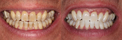 Case: 7585 - before and after photo of 45-54 year old man treated with Zoom Whitening by Robert M. Klaich, DMD