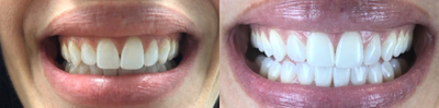 Case: 7586 - before and after photo of 45-54 year old woman treated with Zoom Whitening by Zack Hegazin, DDS