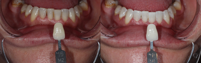 Case: 7588 - before and after photo of 25-34 year old man treated with Zoom Whitening by Andy Shieh, DMD