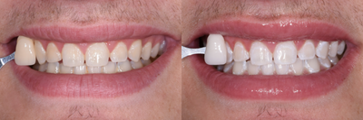 Case: 7589 - before and after photo of ZOOM! In-Office Teeth Whitening by Guy M. Lewis, DDS