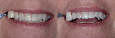 Case: 7590 - before and after photo of ZOOM! In-Office Whitening Treatment by Guy M. Lewis, DDS