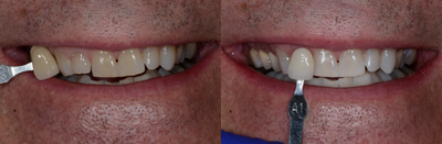 Case 7591 - ZOOM! Teeth Whitening Treatment