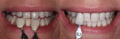 Case 7592 - ZOOM! Teeth Whitening Before Veneers
