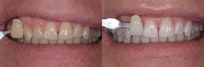 Case 7593 - Zoom Whitening