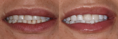 Case 7594 - ZOOM! In-Office Teeth Whitening