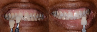 Case 7595 - ZOOM! In-Office Teeth Whitening