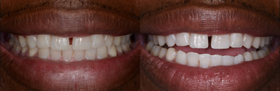Case 7596 - 35-44 year old man treated with Zoom Whitening