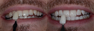 Case 7597 - ZOOM! In-Office Teeth Whitening