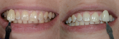 Case 7598 - ZOOM! In-Office Teeth Whitening