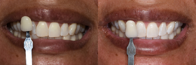 Case 7599 - ZOOM! In-Office Teeth Whitening at TCCD