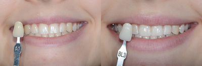 Case 7600 - ZOOM Teeth Whitening!