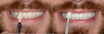 Case 7601 - ZOOM In-Office Teeth Whitening