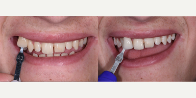 Case 7603 - Our In-Office ZOOM! Whitening Treatment