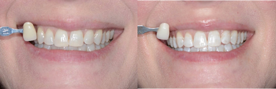Case 7604 - ZOOM! In-Office Teeth Whitening
