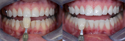 Case 7605 - ZOOM! In-Office Teeth Whitening Treatment