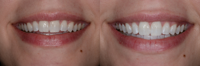 Case 7606 - ZOOM! In-Office Teeth Whitening