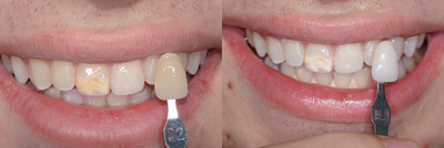 Case 7607 - Zoom Whitening
