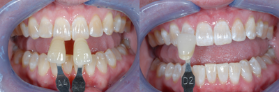 Case 7608 - Zoom Whitening