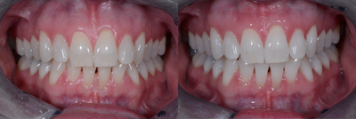 Case 7610 - Zoom Whitening