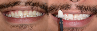 Case 7611 - Zoom Whitening
