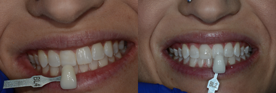 Case 7612 - Zoom! Teeth Whitening in Houston, TX