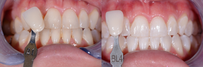 Case 7613 - ZOOM! Whitening Treatment Fixes Stained Teeth