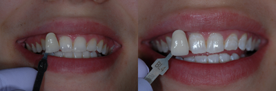 Case 7614 - ZOOM! Teeth Whitening