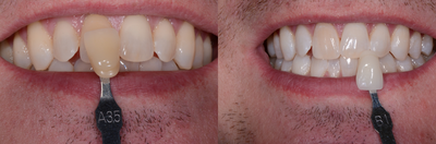 Case 7615 - Zoom! Whitening for Male Patient - Great Results!