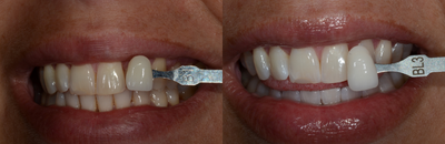 Case 7616 - Zoom! In-Office Teeth Whitening
