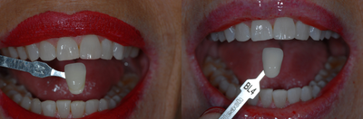 Case 7617 - Zoom Teeth Whitening