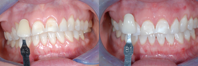 Case 7618 - Zoom Teeth Whitening