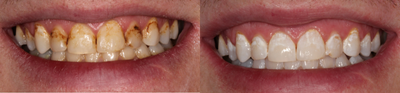 Case 7619 - 25-34 year old man treated with Zoom Whitening