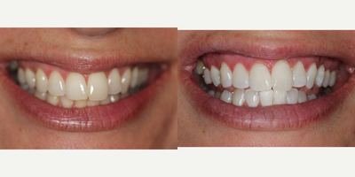 Case 7622 - 35-44 year old woman treated with Zoom Whitening