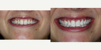 Case 7624 - 18-24 year old woman treated with Zoom Whitening