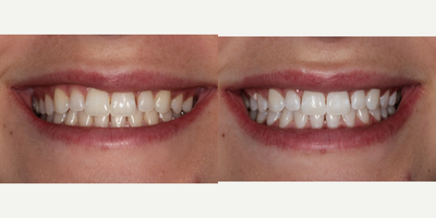 Case 7625 - 18-24 year old woman treated with Zoom Whitening