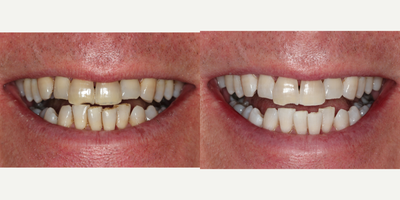 Case 7626 - 55-64 year old man treated with Zoom Whitening