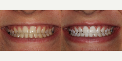Case 7627 - 18-24 year old woman treated with Zoom Whitening