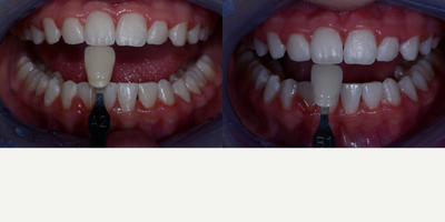 Case 7634 - Zoom! In-Office Teeth Whitening Treatment