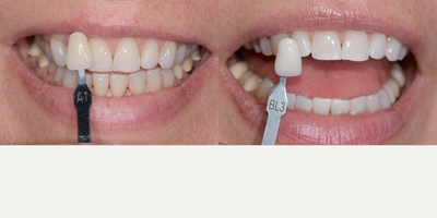 Case 7635 - Zoom Teeth Whitening Treatment