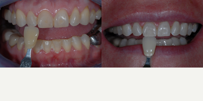 Case 7636 - Zoom Whitening Treatment for Female Patient