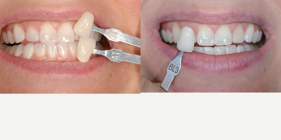 Case 7637 - In-Office Zoom Whitening Treatment for Female Patient