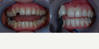 Case 7638 - In-Office Zoom Whitening for Female Patient