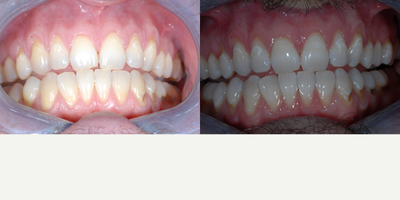 Case 7639 - In-Office Zoom Whitening for Male Patient at TCCD