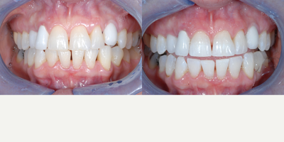 Case 7640 - Zoom Whitening for Female Patient