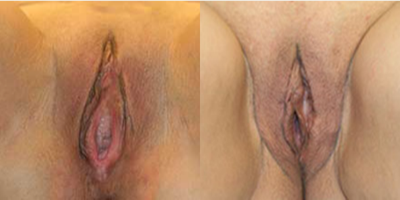 Case: 7671 - before and after photo of Woman treated with Vaginoplasty by Christine A. Hamori, MD