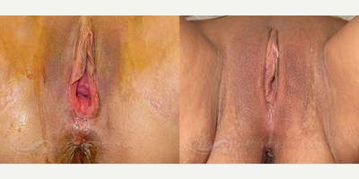 Case: 7672 - before and after photo of 45 year old woman treated with Vaginoplasty by Wesley Anne Brady, MD