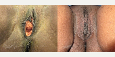 Case: 7674 - before and after photo of 53 year old woman treated with Vaginoplasty by Wesley Anne Brady, MD